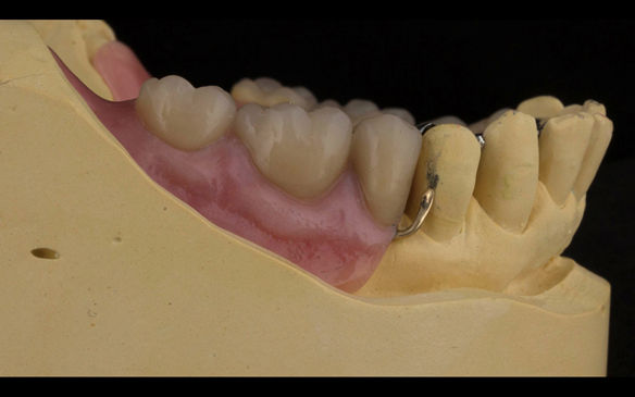 Figure 109 Mk 2 mandibular metal based denture with Schottlander Enigmalife teeth. Gum colouring - Vertex with 0.9 mm wrought gold clasps on LR4 and LL3