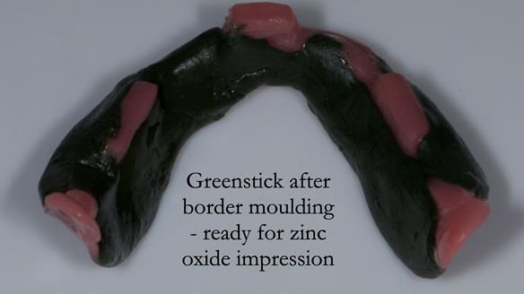 Complete denture Class II div 2 deep overbite Newsletter 39