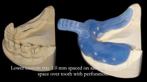 Finlay's Newsletter 61 provision of a lower unilateral free end saddle metal based partial denture for Joyce