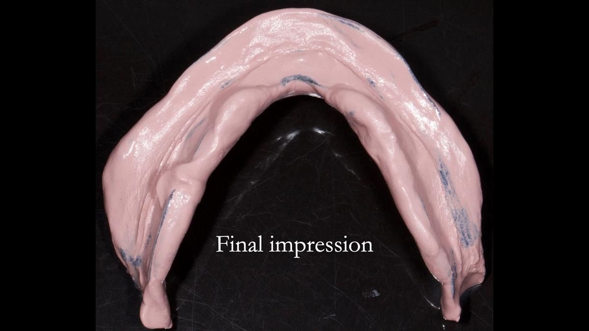 Fin’s Newsletter 88 — Complete dentures - full protocol… he rearranged his own teeth!