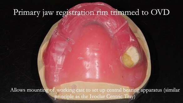 Finlay's Newsletter 58 Gasket upper partial denture for Zoe