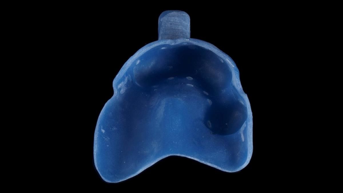 Newsletter 89 – Simon: A Challenging Kennedy Class II Division 1 Upper CoCr Partial Denture with a High Smile Line