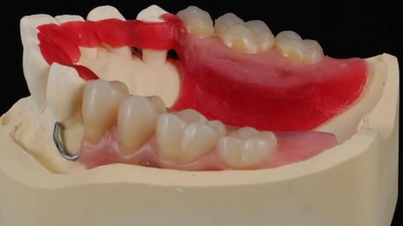 Newsletter 56 showing the making and fitting of a bilateral free end saddle upper removable partial denture (RPD) for patient with pemphigus