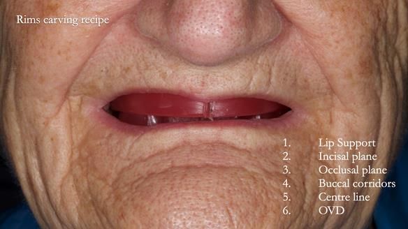Newsletter 83: Sheila’s Complete Denture Success