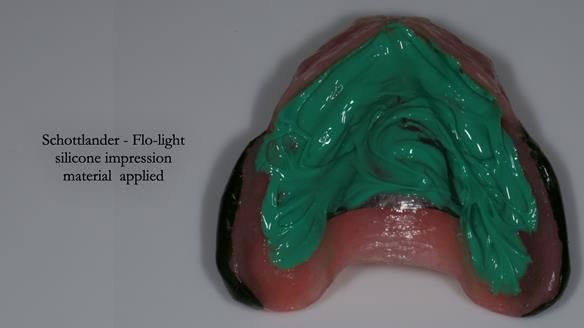 Newsletter 77: Jeremy’s case – immediate complete upper denture