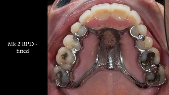 Finlay's Newsletter 63 Case study provision of metal based Scandinavian RPD - functional 10 years on