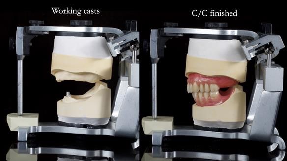 Newsletter 78: What do Clark Gable and a Locator® overdenture have in common?