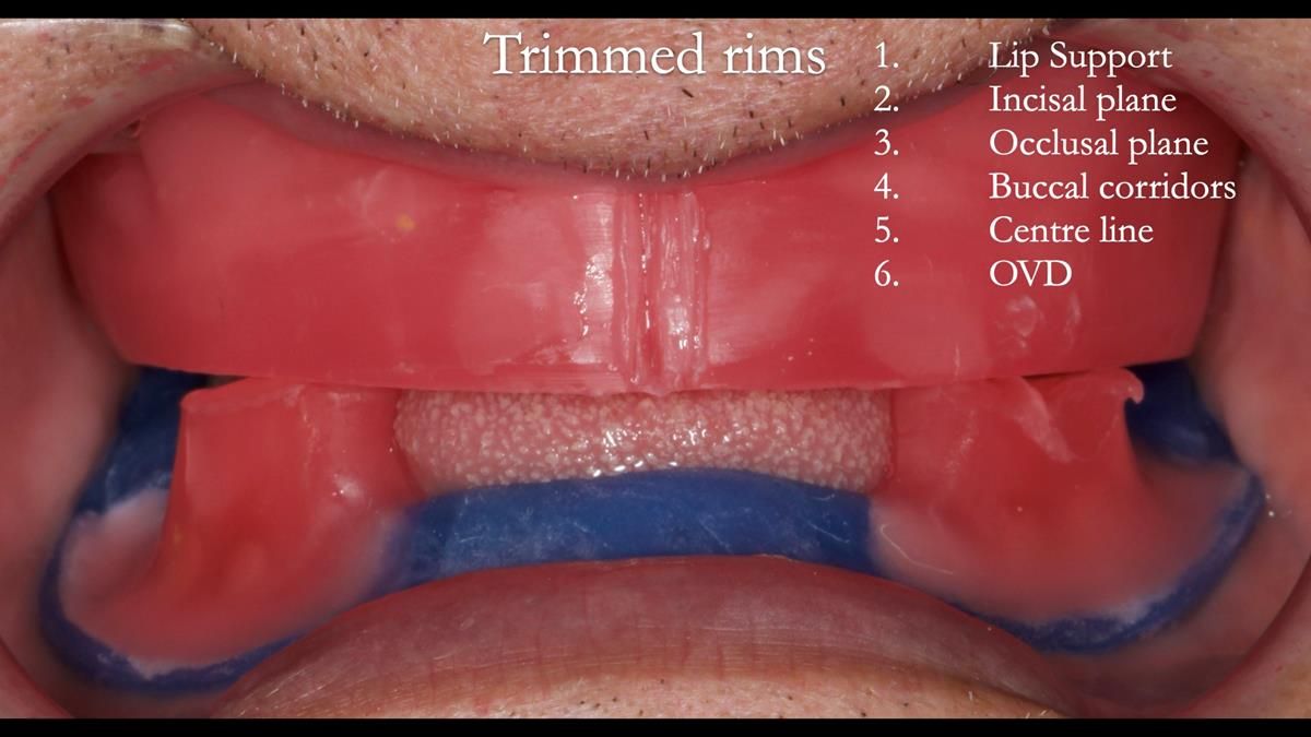 Fin’s Newsletter 88 — Complete dentures - full protocol… he rearranged his own teeth!