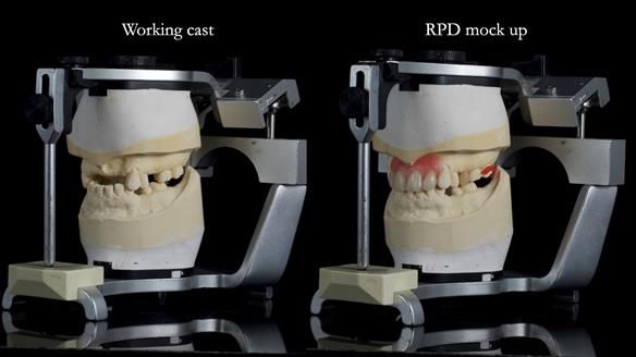 Newsletter 81 - Pam’s Story — how a partial denture changed her life (+ live walkthrough this Thursday)