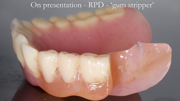 Finlay's Newsletter 59 Ultra hard partial dentures made for Gill