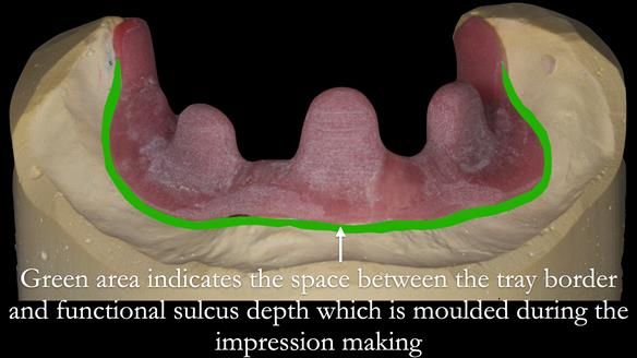 Newsletter 50 Special edition Complete Dentures FULL PROTOCOL