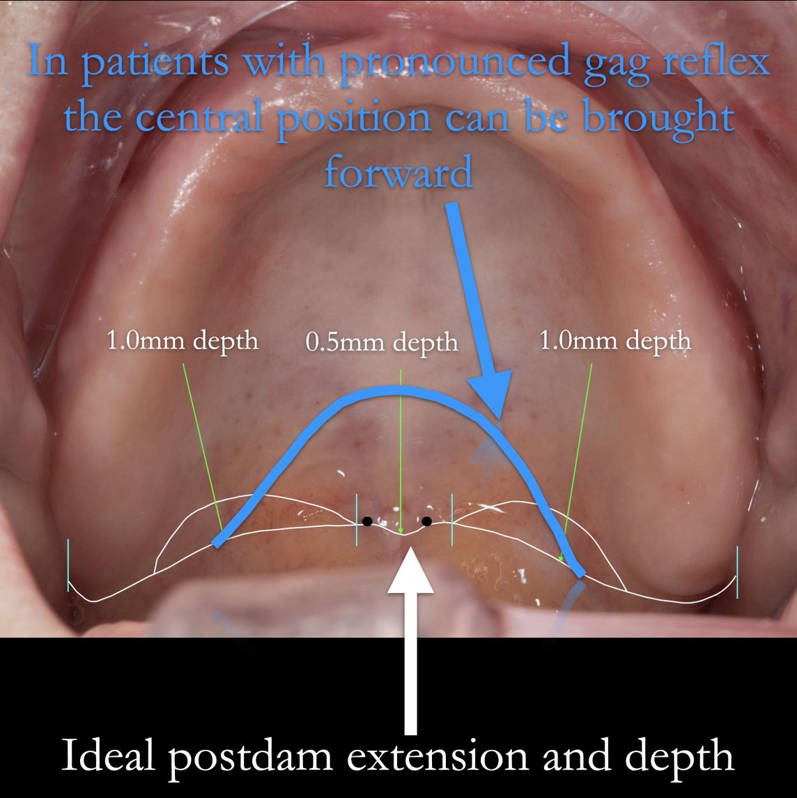 Palatal extension – gag reflex