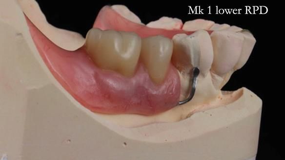 Newsletter 54 case presentation upper complete denture and lower Scandinavian designed hygienic partial denture for David