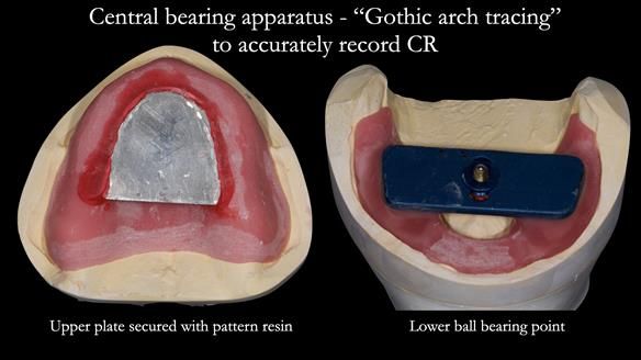 Newsletter 50 Special edition Complete Dentures FULL PROTOCOL