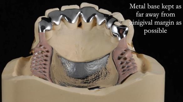 Newsletter 56 showing the making and fitting of a bilateral free end saddle upper removable partial denture (RPD) for patient with pemphigus