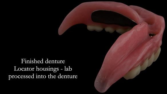Finished metal reinforced implant supported over denture - notice shape of the denture