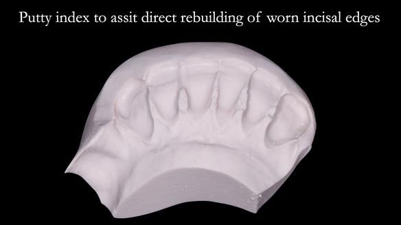 Newsletter 52 Managing Jo’s failing dentition with extractions and Mk 1/Mk 2 complete upper dentures and lower partial dentures FULL PROTOCOL