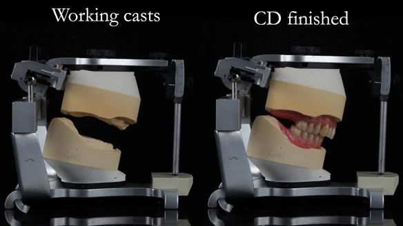 Finlay's Newsletter 62 provision of extractions and metal based complete dentures for Rafique