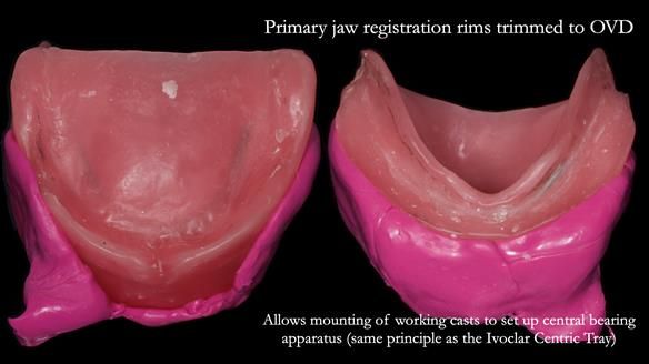 Newsletter 83: Sheila’s Complete Denture Success