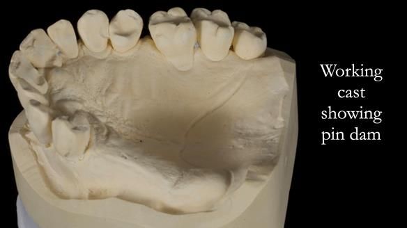 Finlay's Newsletter 64 case study - provision of a Kennedy class 2 metal based Scandinavian RPD for Ian