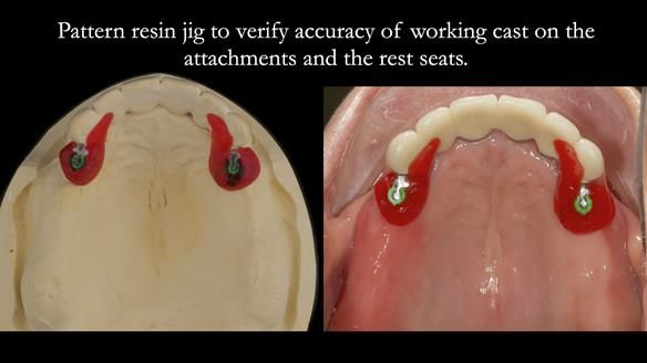 Newsletter 76: Jackie’s case – Telescopic overdenture & precision RPD (the tricky truth!)