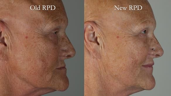 Newsletter 81 - Pam’s Story — how a partial denture changed her life (+ live walkthrough this Thursday)