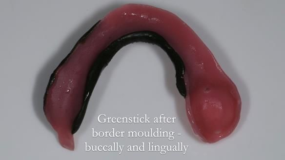 Finlay's Newsletter 59 Ultra hard partial dentures made for Gill