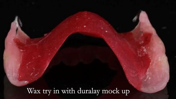 Newsletter 56 showing the making and fitting of a bilateral free end saddle upper removable partial denture (RPD) for patient with pemphigus