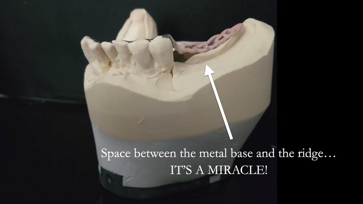 Newsletter 87 – Father Peter: A Partial Denture that needed Minor Miracle