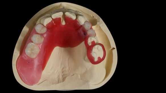 Newsletter 86 Peter the Architect — precision removable partial dentures case study