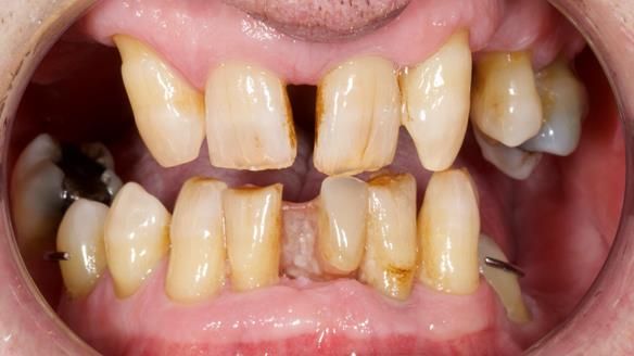 Newsletter 86 Peter the Architect — precision removable partial dentures case study
