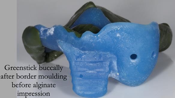 Newsletter 55 Provision of metal based partial dentures for Zephyrine with a repaired cleft lip and palate