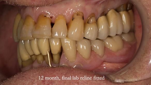 Ken – going downhill, first class