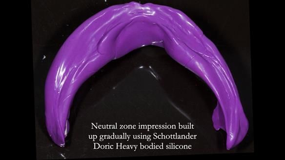 Newsletter 83: Sheila’s Complete Denture Success