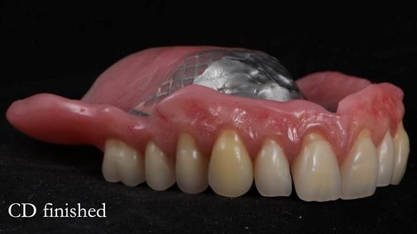 Finlay's Newsletter 62 provision of extractions and metal based complete dentures for Rafique