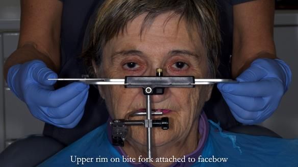 Newsletter 83: Sheila’s Complete Denture Success