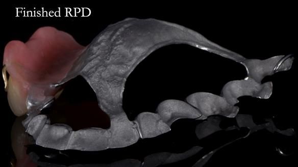 Finlay's Newsletter 64 case study - provision of a Kennedy class 2 metal based Scandinavian RPD for Ian