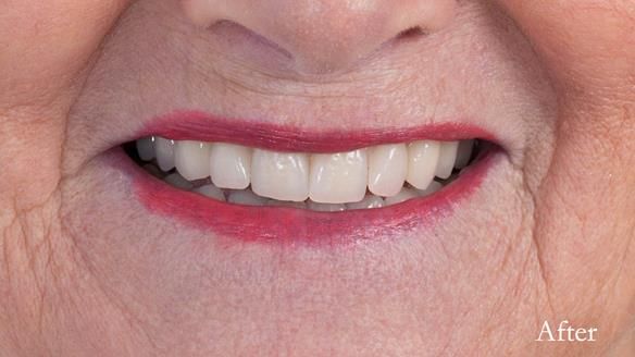 Finished dentures - mimicking Mary’s daughters natural teeth