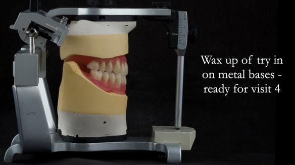 Rowan then uses the carved wax rims to set up the teeth. - teeth ready for try in. - Notice the Class III skeletal arrangement