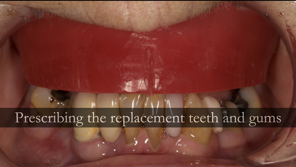 Figure 64 The upper rim is carved with repeated reference to the dentate photograph - figure 65