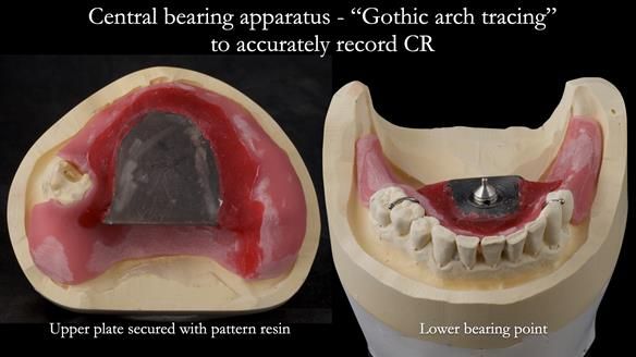 Newsletter 52 Managing Jo’s failing dentition with extractions and Mk 1/Mk 2 complete upper dentures and lower partial dentures FULL PROTOCOL