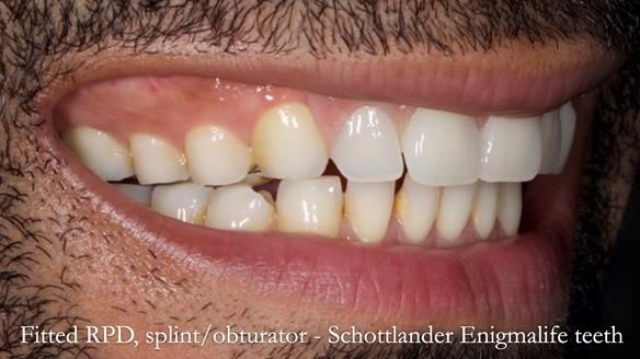 Upper metal base partial denture/occlusal stabilisation splint/obturator - full protocol