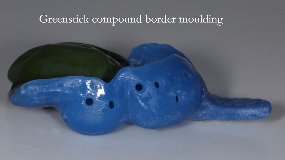 Newsletter 89 – Simon: A Challenging Kennedy Class II Division 1 Upper CoCr Partial Denture with a High Smile Line