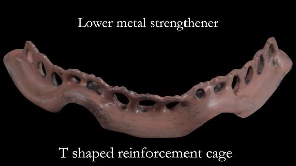 Newsletter 50 Special edition Complete Dentures FULL PROTOCOL