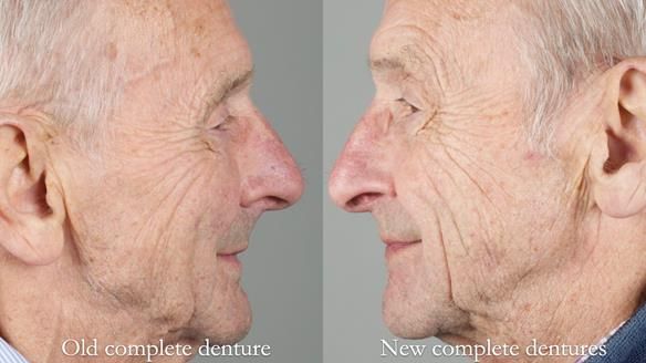 Newsletter 80 - Gordon’s dentures: the one case in 1,000 where my technique failed