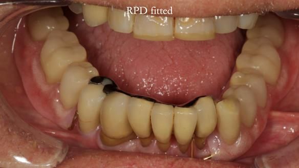 Ken – going downhill, first class