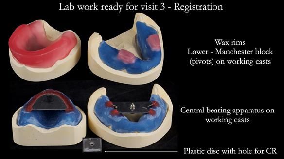 Newsletter 53 showing the making and fitting of ultra life-like dentures for Valena
