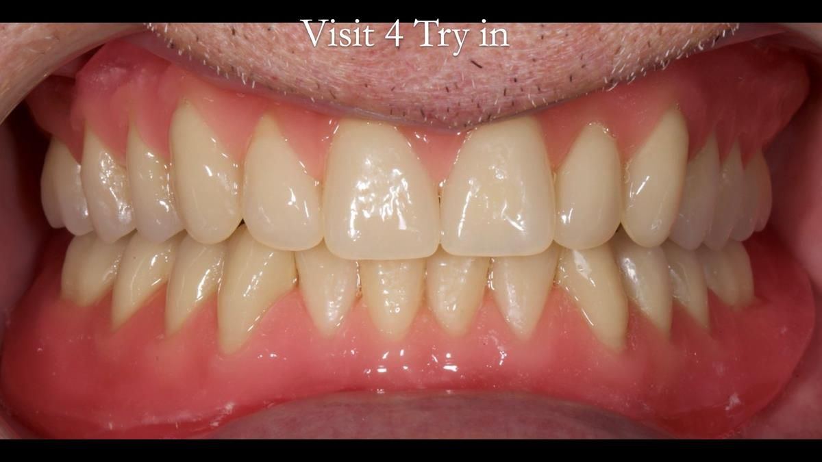 Fin’s Newsletter 88 — Complete dentures - full protocol… he rearranged his own teeth!