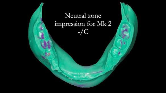 Replacing Madeline’s Complete denture FULL PROTOCOL