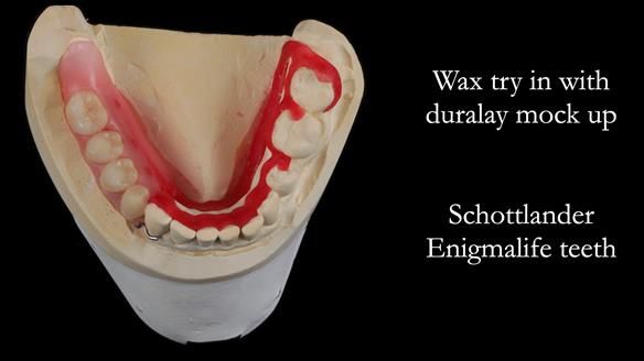 Finlay's Newsletter 61 provision of a lower unilateral free end saddle metal based partial denture for Joyce